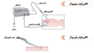انواع دستگاه الکتروکوتر